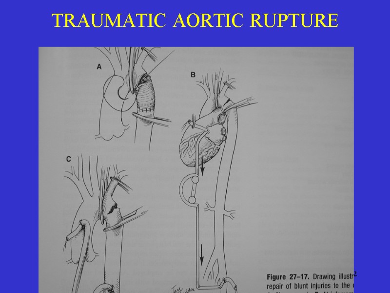 32 TRAUMATIC AORTIC RUPTURE